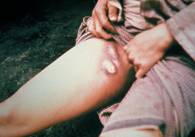 Bubones/ Ganglios Linfáticos Inflamado por Yersinia Pestis