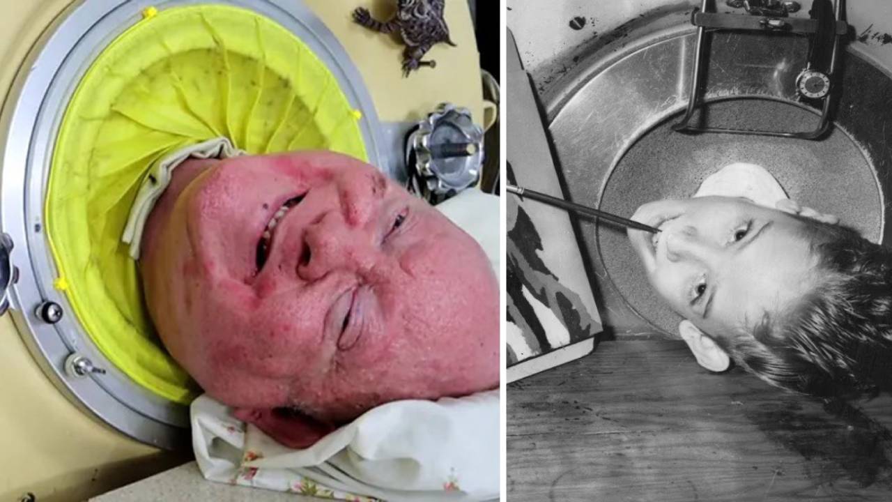 El hombre del pulmón de hierro, unido a un ventilador desde 1952