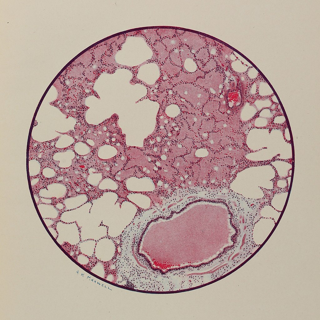Sección microscópica de pulmón humano por envenenamiento con capa de fosgeno de An Atlas of Gas Poisoning, 1918