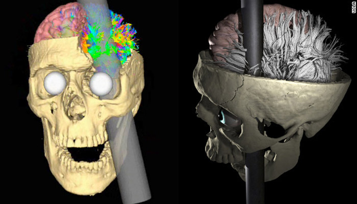 Phineas Gage ¿Cómo sobrevivió a una barra de acero que le atravesó y destruyó el lóbulo frontal?