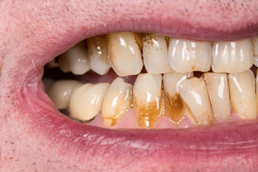 Cómo eliminar el sarro de los dientes: La guía definitiva para deshacerte de este problema