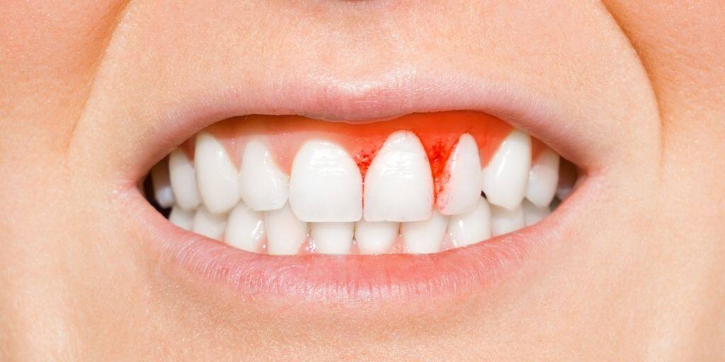 Cómo eliminar el sarro de los dientes: La guía definitiva para deshacerte de este problema
