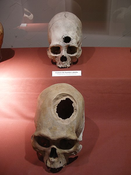 Operación de cráneos en la antigüedad ¿Por qué los Incas eran especialistas en esta práctica?