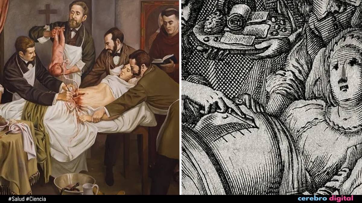 La primera cesárea de la historia a una mujer viva