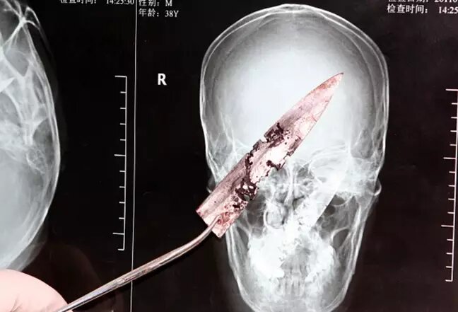 Li Fuyan: el hombre que vivió cuatro años con un cuchillo en la cabeza