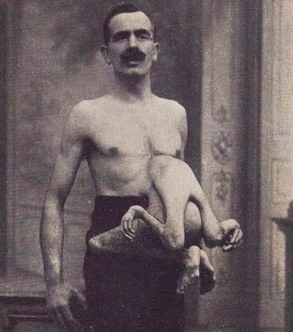 Jean Libbera: el hombre que nació con su gemelo parasitario creciendo en su abdomen