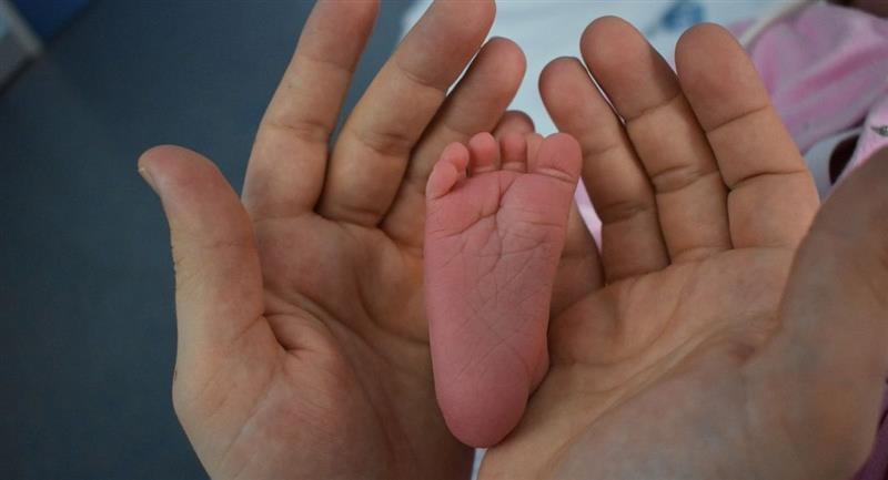 Niña nace con 26 dedos en manos y pies: Un extraño caso de polidactilia
