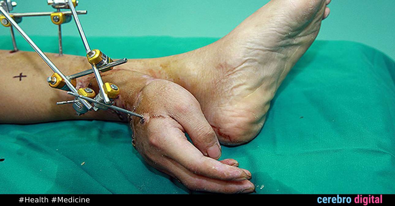 Transplanting a Hand to the Ankle to Save It: One of the Most Astonishing Medical Cases