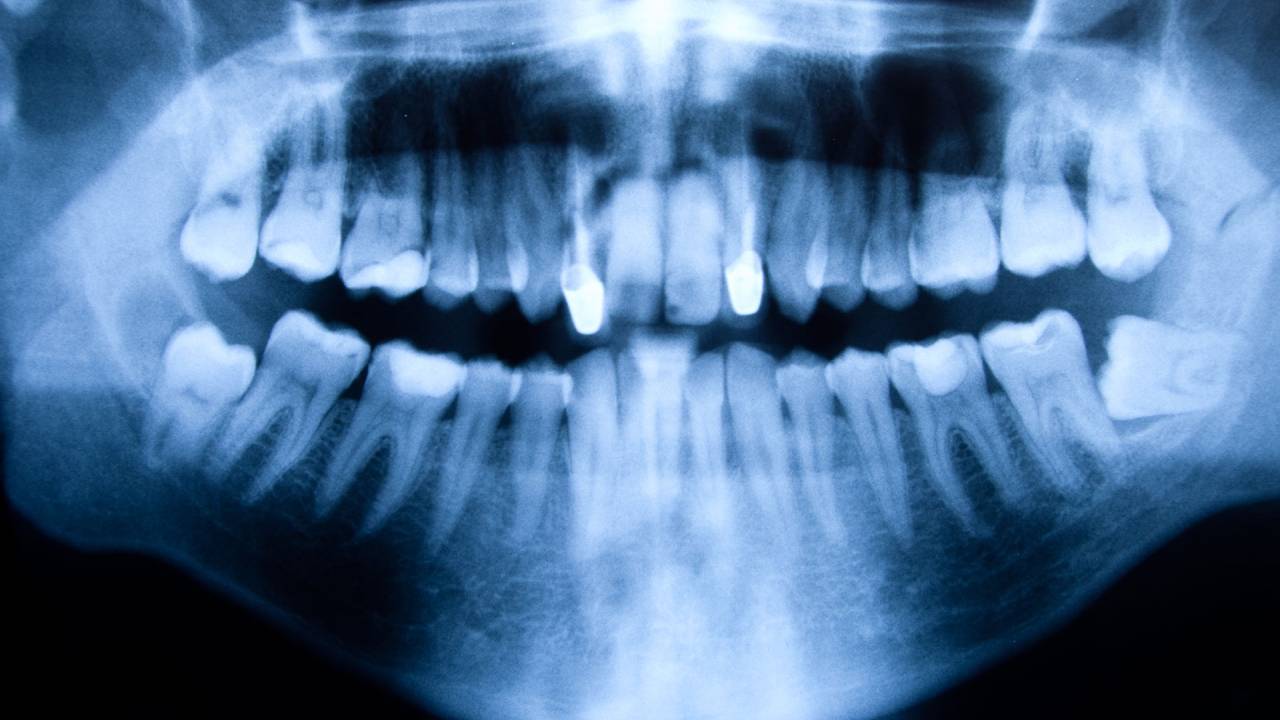 ¿Una infección podría ser la causa del Alzheimer?
