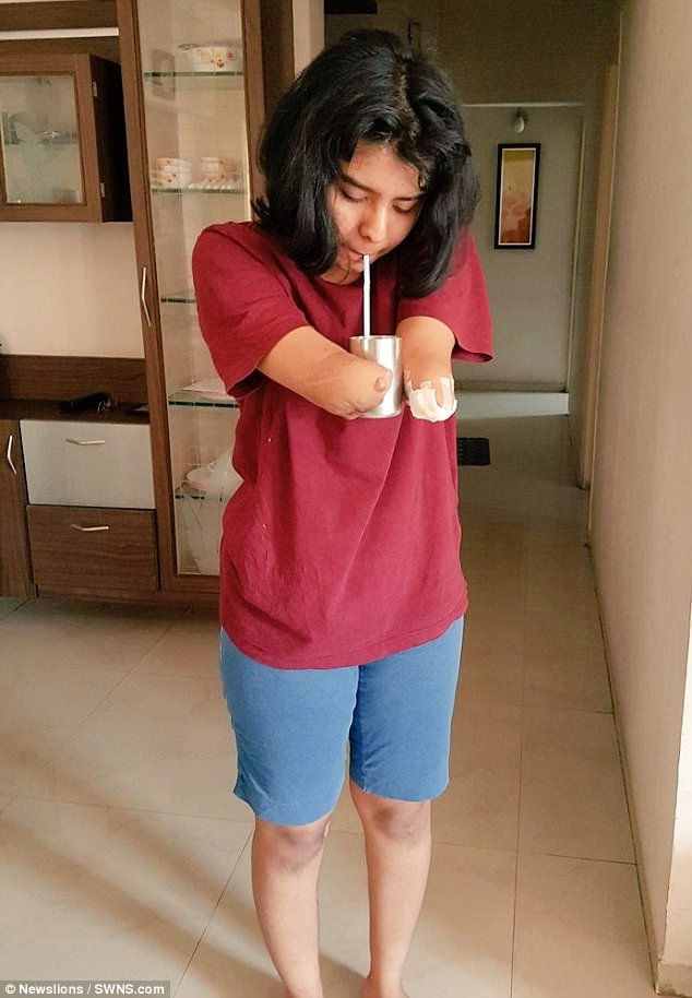 The case of Shreya Siddanagowda: A man's arm transplant adapting to her female body