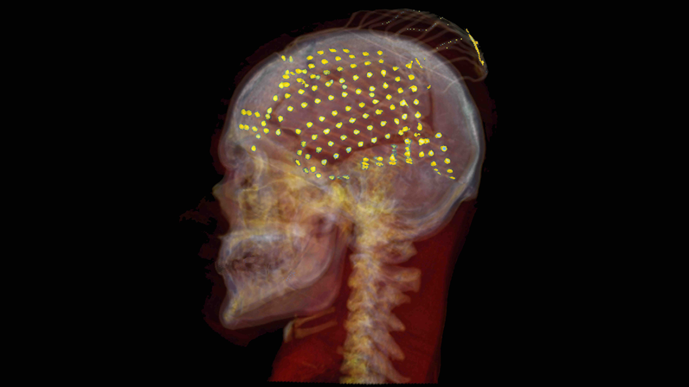 Nueva investigación podría devolver el habla perdida a través de la decodificación neuronal