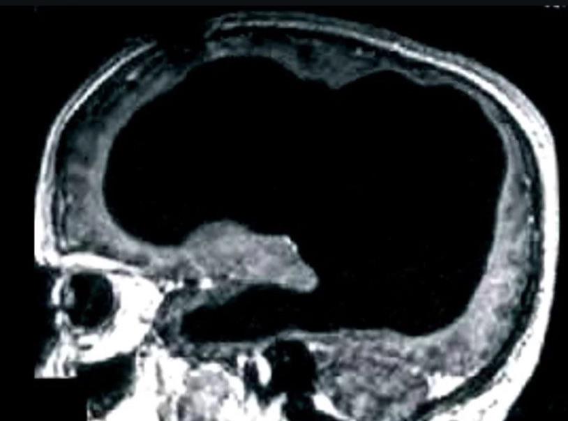 El extraño caso del hombre que vivía sin el 90% de su cerebro