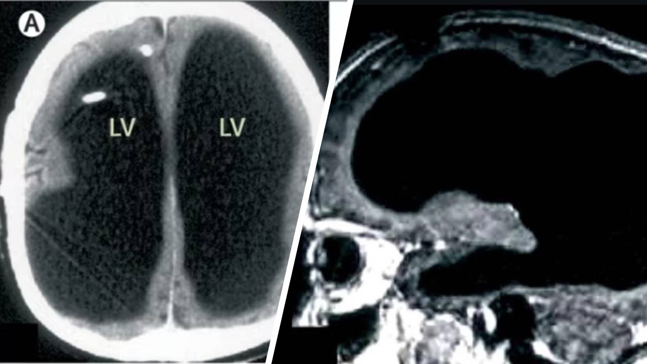 El extraño caso del hombre que vivía sin el 90% de su cerebro