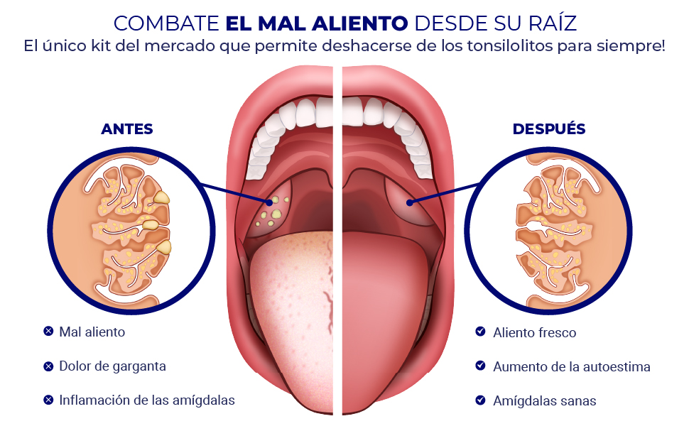 Tonsilolitos: Qué son y cómo afectan la salud bucal