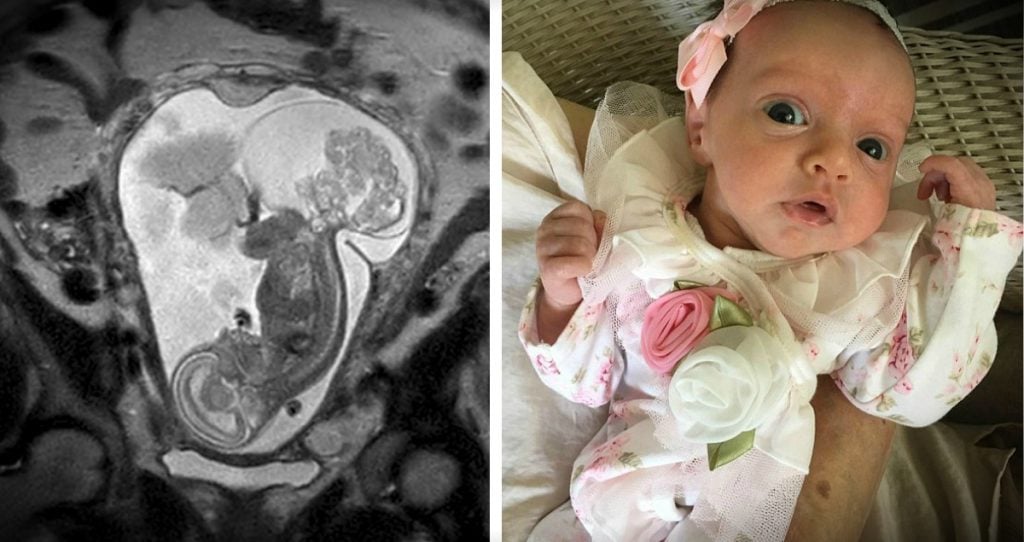 Lynlee, la niña que nació dos veces