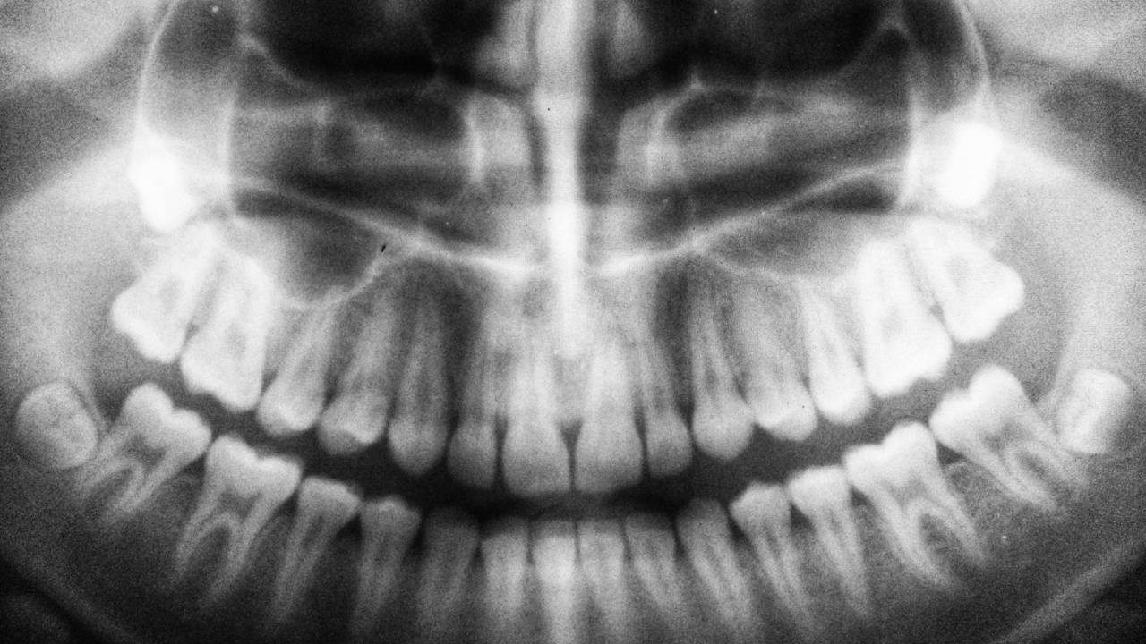 Los humanos están evolucionando para perder dientes