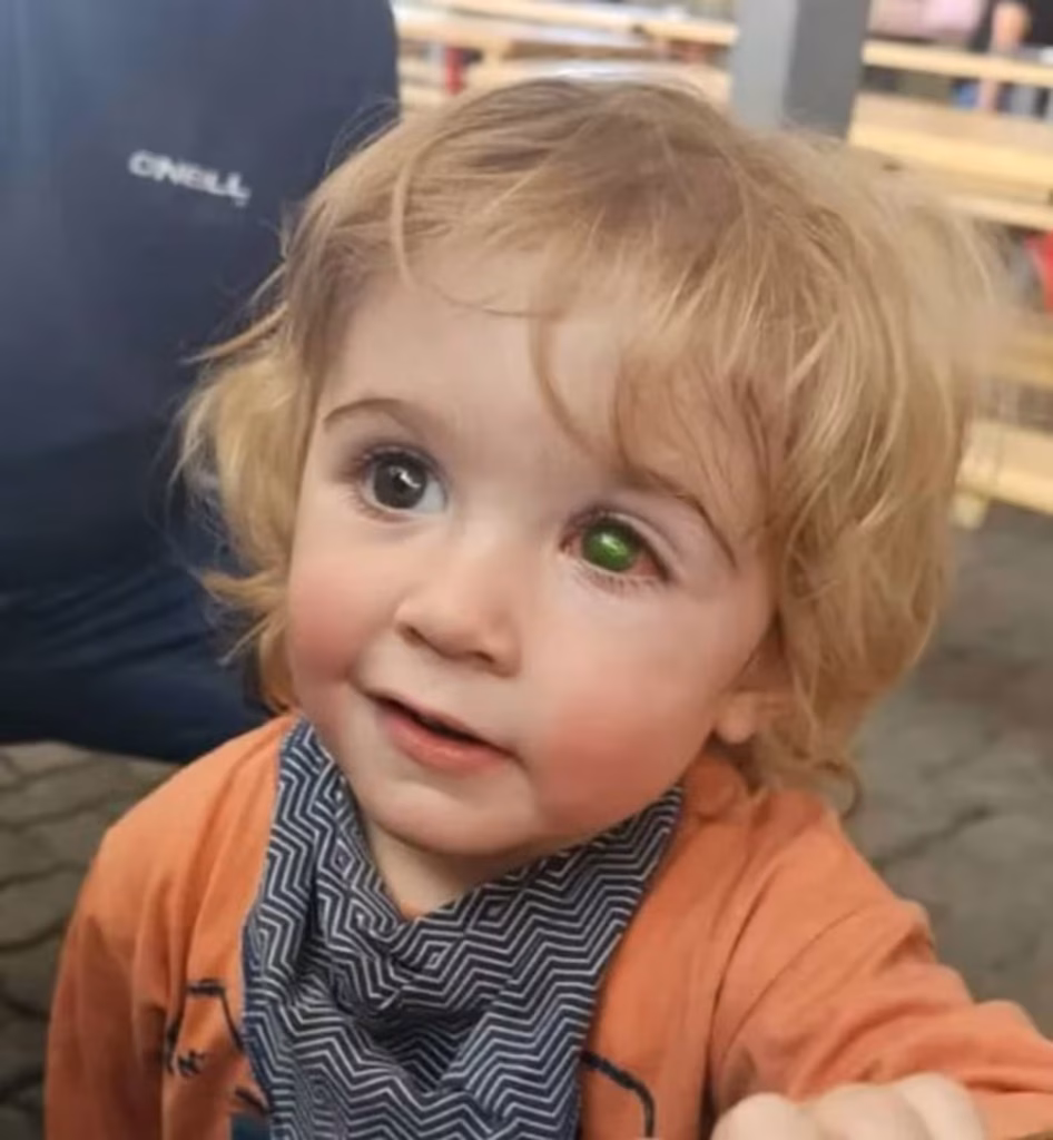 Niño pierde la visión de un ojo tras ser besado por una persona