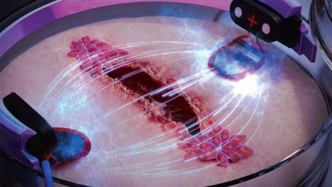 Médicos consiguen usar electricidad para curar heridas